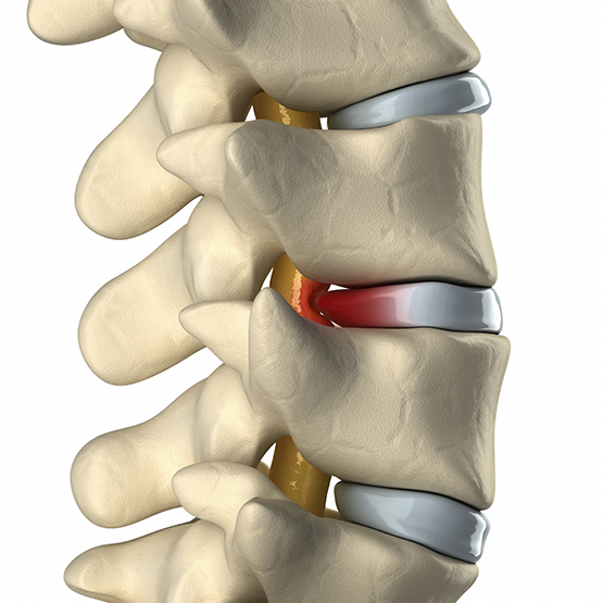 Disc Problems | Acupuncture Chicago IL